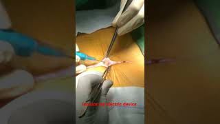 Laparotomy incision  medical knowledge  viral short  trend video  views [upl. by Atinhoj]