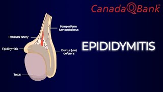 Epididymitis [upl. by Gish722]