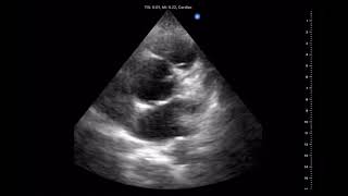 Ultrasound images of my excited heart [upl. by Jessamyn]