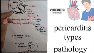 Pericarditis types in hindi pathologyGeneral review PART2serous fibrinoussuppurative [upl. by Oirasor]