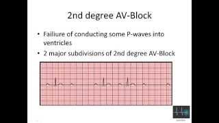 ECG cardiac arrhythmias [upl. by Sallyann216]