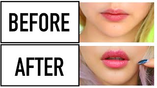 Permanent Lip Filler Effect With Your Teeth ♥ Before amp After Wengies 6 month Invisalign Journey [upl. by Straub]