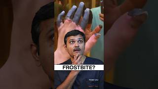 Vascular Surgeon Reacts to quotDEAD Fingersquot shortsviral frostbite drsumitkapadia [upl. by Othilie924]