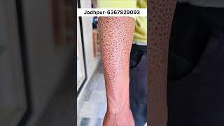 Ichthyosis skin diseaseshorts । [upl. by Griff]