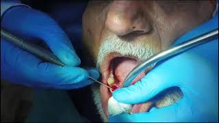 Live Tooth Implant Processdentist health care tooth [upl. by Det]