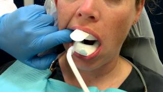 Fluoride Tray Placement and Procedures [upl. by Moclam]