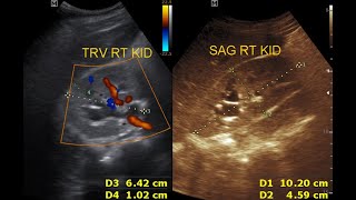 Ultrasound cases 200 of 2000  Chronic pyelonephritis [upl. by Amoeji]