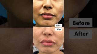 ⚡Lip Transformation  💋 Lip Filler Treatment Before and After  short shortsfeed [upl. by Adias]