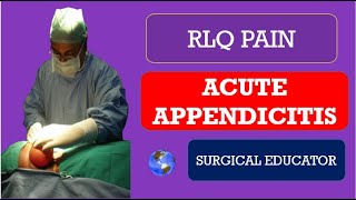 ACUTE APPENDICITIS How To DIAGNOSE amp TREAT  RLQ PAIN [upl. by Musette929]