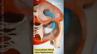 Transcatheter mitral valve replacement 😃 shorts short viralvideo [upl. by Ortrude]