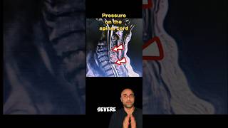 Cervical Myelopathy explained neckpain spine surgeon cervical awareness cervicalpain shorts [upl. by Sabah]