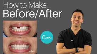 Dental Marketing How to Create Before and After [upl. by Karmen]