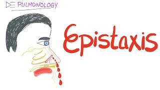 Epistaxis nosebleed Causes and Management [upl. by Olsen]