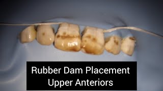 How to Isolate with Rubber Dam in Upper Anteriors  Rubber Dam Placement in Maxillary Front Teeth [upl. by Latsyrhk]