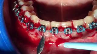 Incision interdental Periodoncia [upl. by Flory]