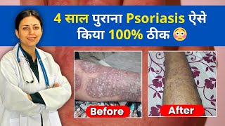 Psoriasis को कैसे ठीक करें  Skin Psoriasis Treatment  Dr Upasana Vohra Patient Review [upl. by Lidda]