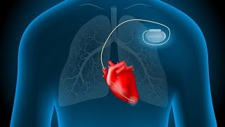 Placement of a pacemaker on the patients ♥ [upl. by Elden]