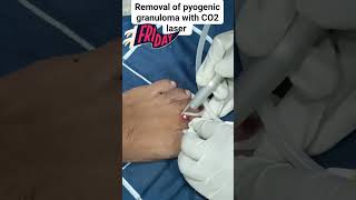 Removal of pyogenic granuloma with CO2 laser [upl. by Anaz]