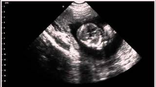 Fetal Heartbeat ultrasound [upl. by Annig]