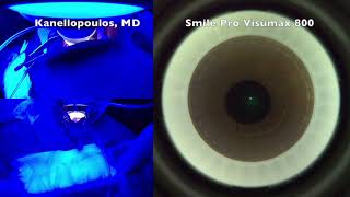 Visumax 500 and 800 the evolution of Smile to Smile pro Kanellopoulos MD [upl. by Dickman]