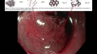 Imaging of a poorly differentiated adenocarcinoma of the stomach with signet ring cells [upl. by Trust]