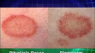 Ringworm Explained Medical Course [upl. by Sarita702]