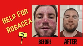 Help For Rosacea and Acne [upl. by Cayla]