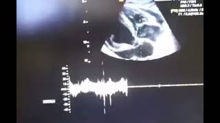 Cardiac tamponade echocardiography [upl. by Davison]