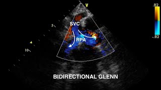 Bidirectional Glenn Procedure Echocardiography [upl. by Eladnor454]