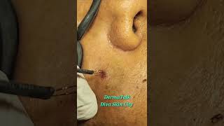 Mole Removal by Radio Frequency Ablation [upl. by Ane]