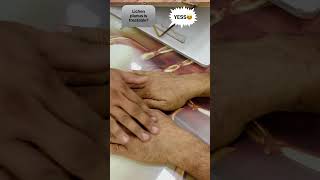 Lichen planus treatment [upl. by Artina528]