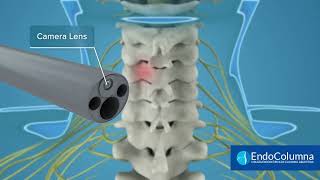 Endoscopía Cervical [upl. by Brottman]