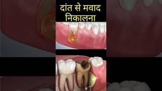 Dental abscess  Pus discharge from gum  Dr Lahna Singh teeth toothdecay [upl. by Auqenet9]