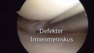 Orthodoctv  Orthpädie am Gasteig  Arthroskopie Knie Meniskusschaden arthroscopic knee surgery [upl. by Lessur4]