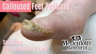 How to Pedicure Extremely Calloused Feet and Toes ASMR [upl. by Nudd692]