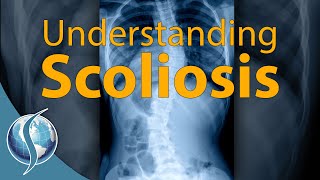 Understanding Scoliosis [upl. by Meyeroff]