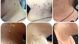 Skin tag removal  part 1 application [upl. by Haggerty796]