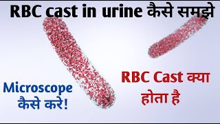 rcb cast in urine I crystals in urine under microscope [upl. by Endaira790]