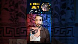 Alopecia Ateata treatment doctor dradnankhan alopecia alopeciaareata [upl. by Shinberg]