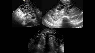 Chest FRCR2b CASES [upl. by Kelci]