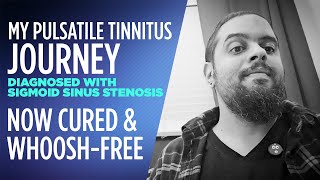 I cured my Pulsatile Tinnitus and now whooshfree diagnosed with Sigmoid Sinus Stenosis [upl. by Sauer170]