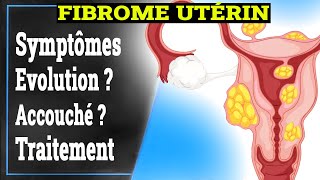 Fibrome Utérin Symptômes Causes Traitement  Gynécologie [upl. by Ibob]