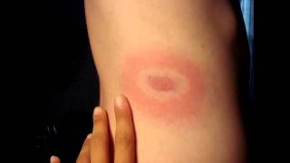 Erythema Chronicum Migrans from Ixodes Tick Bite Lyme Disease Borrelia [upl. by Ytte]