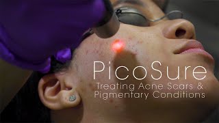 PicoSure Laser for Acne Scars amp Pigmentation [upl. by Atenaz694]