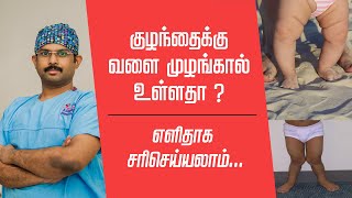 குழந்தைகளுக்கு வளை முழங்கால் உள்ளதா  பயப்பட வேண்டாம்Bowed Legs amp Knock Knees [upl. by Maharba]