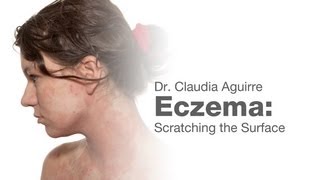 Eczema Scratching the Surface [upl. by Tennes]