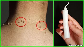 With a candle get rid of skin tags in just 3 days proven and effective💯 [upl. by Ttennaej]