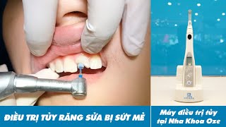 Trực tiếp điều trị tủy răng cửa do bị sứt mẻ  Nhakhoaozecom [upl. by Coney]