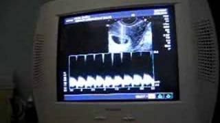 Babys Heartbeat at 7 Weeks [upl. by Estis]