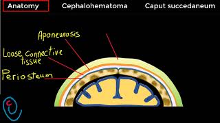 Cephalohematoma versus Caput succedaneum [upl. by Manuela315]